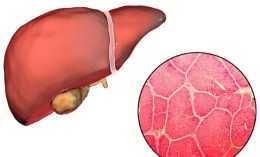 減輕肝纖維化就是挽救肝臟走向嚴重的關鍵階段