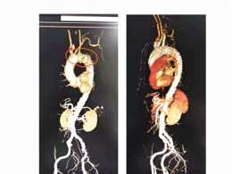 主動脈瘤橫跨三條大血管 廣醫一院實施"三開窗"技術不斷血"拆彈"