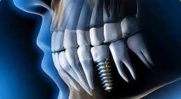 為什麼有些人種植牙需要植骨？