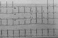 【醫脈通】心臟檢查中的心電圖，你真的瞭解嗎？看完大吃一驚！