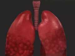 【健康】肺不好的人，身體有1粗2痛3多，這些訊號一定要知道