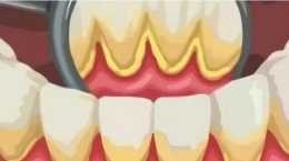 “牙結石”可以自己摳掉嗎？這幾招也許能幫到你