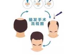 上海萊森：頭髮有疤痕可以做毛髮移植嗎?